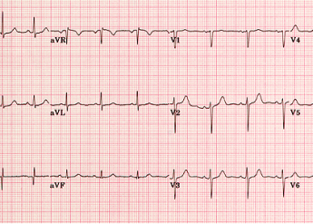 EKG (Elektrokardiografija)