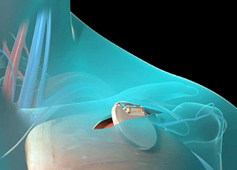 Ugradnja pejsmejkera – procena